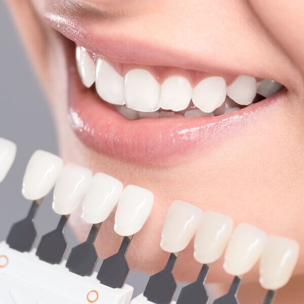 How are Veneers Fitted?